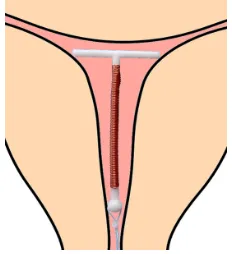 Table 1 Fundal transverse diameter (mm) according to age and parity (Kurz Cavimetric measurements8)