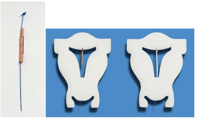 Figure 7 The current intrauterine device (IUD) is provided with a “visualized” anchor.Notes: The anchor with visualization element (magnification × 1.5) consists of the anchoring knot and a tiny medical grade stainless steel element (AISI 316L/1.4404) (2 m