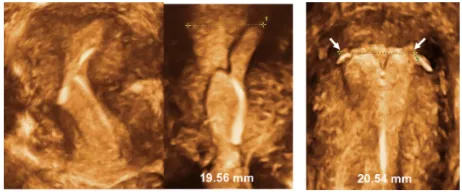 Figure 8 3-D ultrasonography: Abnormally located ParaGard intrauterine device (IUD) causing bleeding and pain (left) and middle (Mirena)