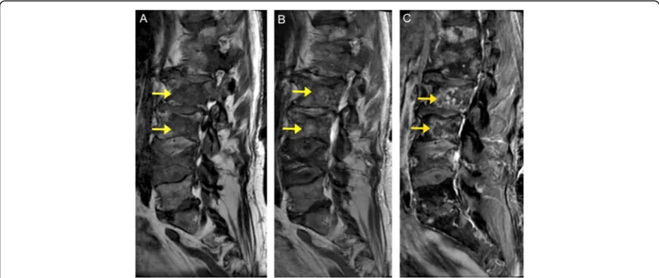 Fig. 13 Pyogenic spondylodiskitis. Sagittal STIR image (a) demonstrates abnormal marrow signal of C2, C3, C5, C6, and C7 (asterisks) with diffuseparavertebral soft tissue edema