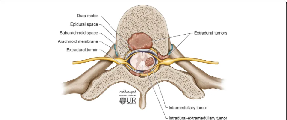 Fig. 1 Classification of spinal tumors by location. Spinal neoplasms can be classified according to their anatomic locations, specifically extradural,extramedullary-intradural, and intramedullary tumors