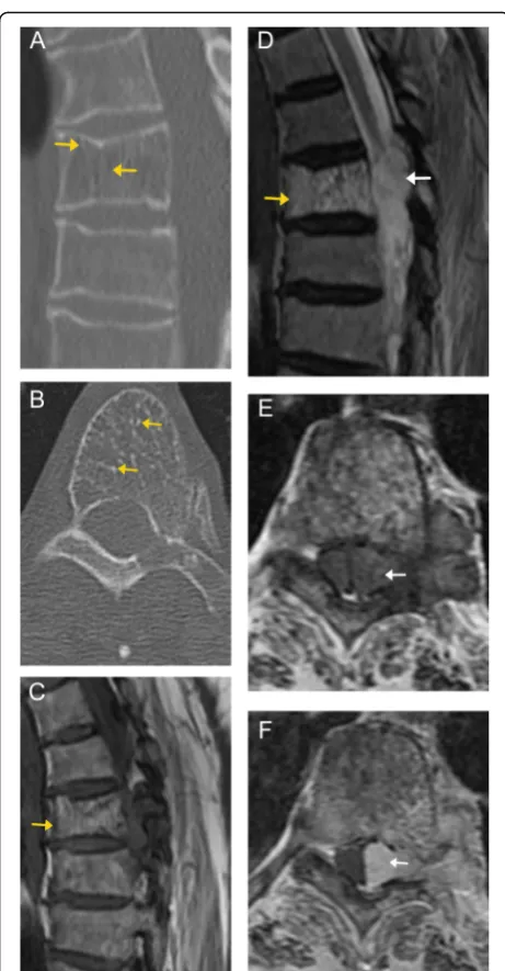 Fig. 2 Compressive vertebral venous vascular malformation. Sagittal(a) and axial (b) CT images in the bone window of the thoracicspine demonstrate decreased attenuation of the T4 vertebral body,as well as the left pedicle and transverse process