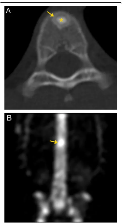 Fig. 6 Osteoid osteoma. Axial CT image (a) demonstrates a 1.2-cmsclerotic nidus (asterisk) at T10