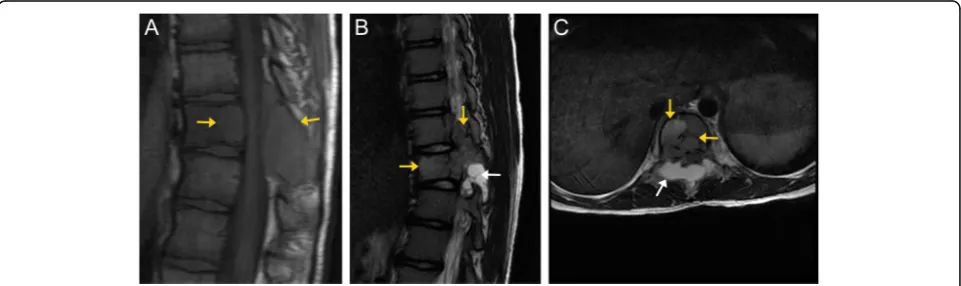 Fig. 7 Osteoblastoma. Axial (the T7 vertebral body and posterior elements (orange arrows), as well as invasion of the adjacent paraspinal soft tissues