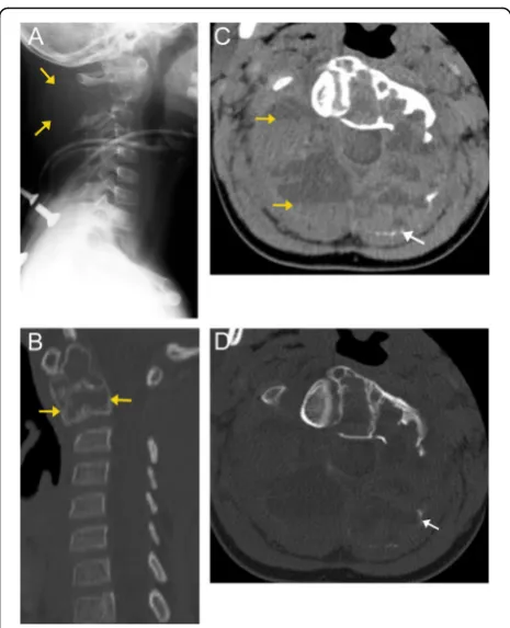 Fig. 9 Aneurysmal bone cyst. Lateral radiograph (a) of the cervicalspine demonstrates a large, osteolytic, expansile mass arising fromthe C2 vertebral body, resulting in significant bony remodeling