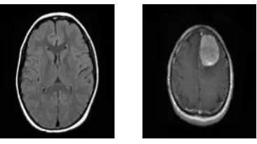 Figure 2: (a) Non-tumor MRI image (b) Tumor MRI image 
