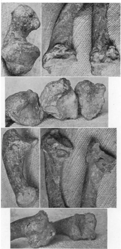Figure 4. Proximal ends of first three metacarpals of right hand of 28 AA, showing ulnar, joint, and 