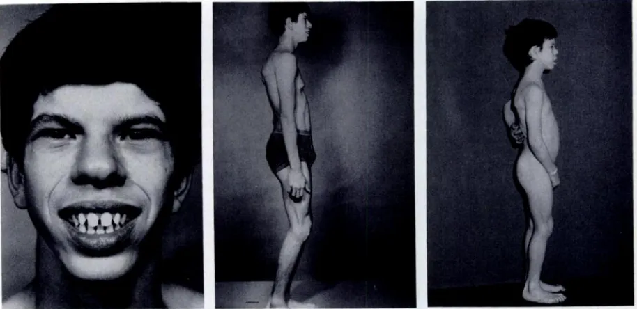 Fig 1.Patientinwith1. Top,at 30 monthsof age, typicalfaciesearlychildhood.Noteperiorbitalpuffiness,medialflareof eyebrows,thicklips,smallteeth.Middle,stiffgaitlimitationofjointmovement.Notetypicalfacial