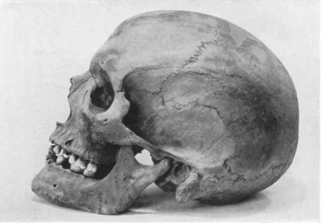 Fig. 3. Skull with diseased Tooth 