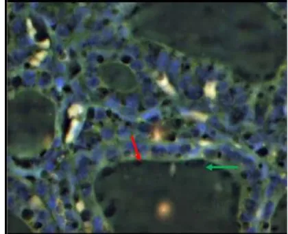 Figure 1:  Tissue section of thyroid follicular adenoma by FISH analysis showing two separate green (2G) signals, two separate orange (2O) signals repeating the two normal PAX8-PPAR G loci