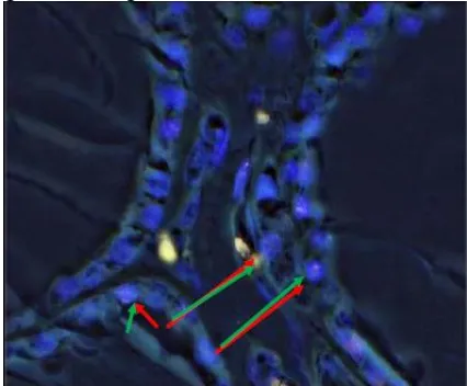 Figure 6:  Tissue section of thyroid follicular carcinoma by FISH analysis showing aberrant cell: one green (1G), one orange (1O) two green –orange (2GO) fusion signal, including a fusion of PAX8 and PPARG