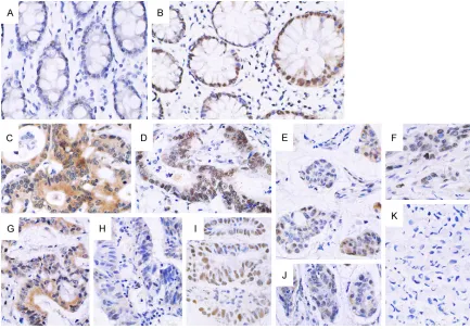 Figure 1. Expression of the AKAP95 protein in pericarcinoma specimens and rectal cancer tissues (×400)