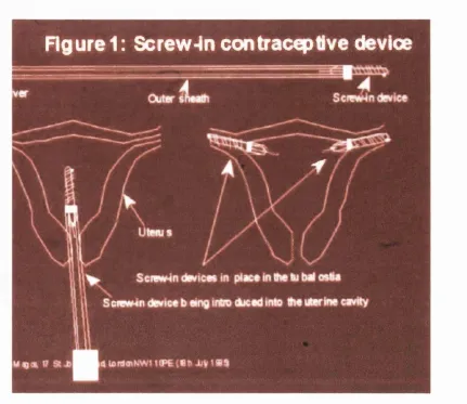 Figure 1.2 The intratuba I screw mounted on applicator and applied to 