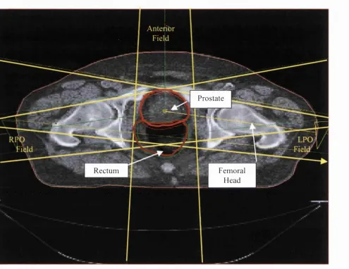 Fig. 1.1 Central Planning CT Slice (Prostatic Carcinoma)