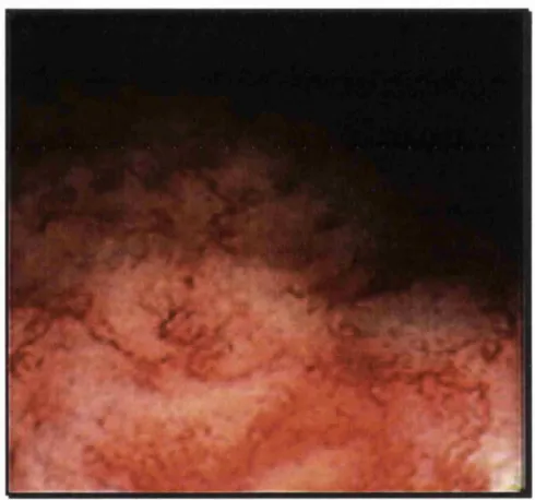 Fig. 1.3 The sigm oidoscopic appearance of radiation proctitis