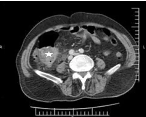 Figure 1 The CT scan axial cut revealed diffused bladder wall thickening (whitearrow).