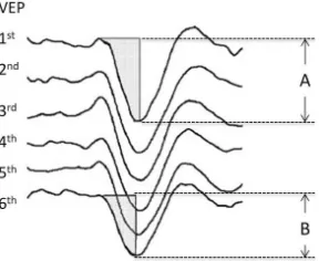 Fig. 1 VEPs habituation in a healthy subject. A: 1st VEP descend range; B: 6th VEP descend range