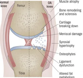Figure 1.1: Comparison between normal and osteoarthritic knee (Hunter, 2011)