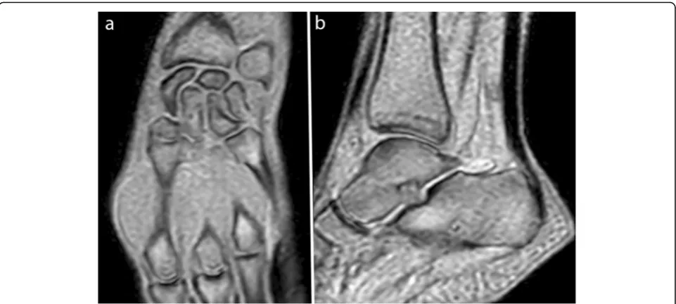 Fig. 4 Real-time dynamic MR image obtained with the UFGEsequence at 3.0 T. Finger in the sagittal plane in flexion (TR, 4.7; TE,2.3; flip angle, 15°; pixel size, 1.09 × 1.46 mm)