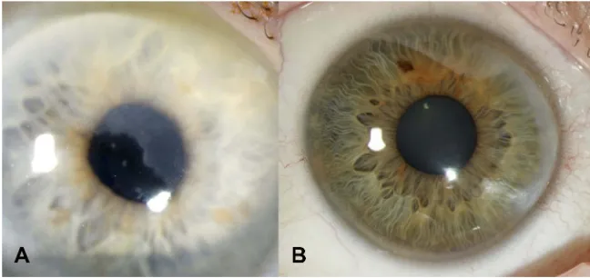 Figure 2 (A) Anterior segment optical coherence tomography (AS-OCT) of the right eye horizontally and (B) vertically in patient 1, demonstrating mostly continuous,homogenous, well-demarcated hyperreﬂective subepithelial band respecting the Bowman layer (arrow) while rarely breaking through and expanding slightly into the anteriorstroma (star) (C) oblique in vivo confocal microscopy (IVCM) of patient 1 demonstrating normal structured epithelium, underlying ﬁbrotic structures, intact Bowman layer(arrowhead) and normal anterior stroma.