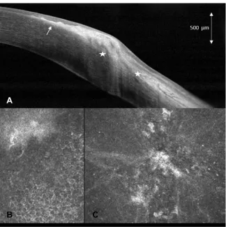 Figure 3 (A) anterior segment optical coherence tomography (AS-OCT) of the right eye in patient 2, demonstrating mostly continuous, slightly nodular, well-demarcatedhyperreﬂective subepithelial band partially breaking through the Bowman layer (arrow) and e