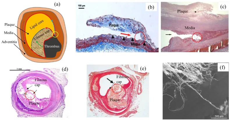 Fig. 1.1 Images of arterial delamination events: (a) A schematic image of a ruptured plaque, with rupture circled; (b) plaque delamination from the underlying media layer (blue arrow) (Wang et al., 2013); (c) delamination within the media layer (Madaloso a