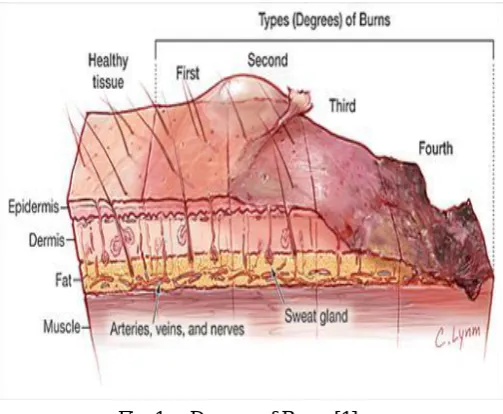 Fig. 1. Degrees of Burns [1] 