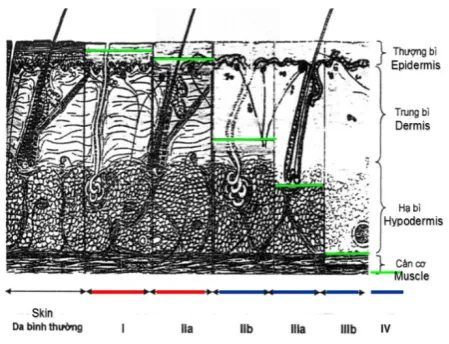 Fig. 4. Different depth levels of burns and scalds [3,15] 