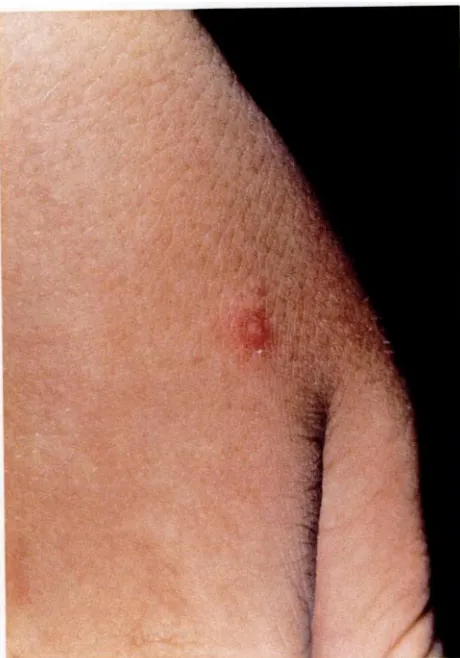 FIg 3.Small(3-mm)papuleonc