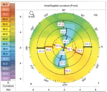 Figure 2 Scheimpflug imaging (Pentacam, Oculus) of the corneal front surface in patient 2.