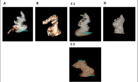Table 2LAA dimensions in the 4 morphologic types of theLAA. The cactus morphology was associated withthe largest LA diameter but smallest LA volume.The windsock morphology was associated with thelargest summarizes the differences in the LA andLAandLAAvolumes.Thecauliflowermorphology was associated with the smallest LA