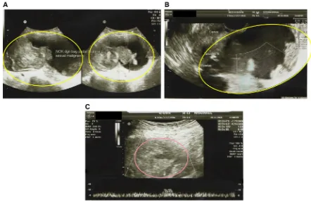 Figure 1 Bilateral cystic adnexal mass (A) with a solid region (B) and low-resistance neo-vascularization on ultrasound (C).Note: The yellow circles highlight the whole cystic adnexal mass (A) and the solid region (B)