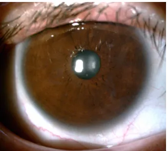 Figure 3 Four months after surgery, the corneal flap is clear and smooth in situ without epithelial ingrowth.