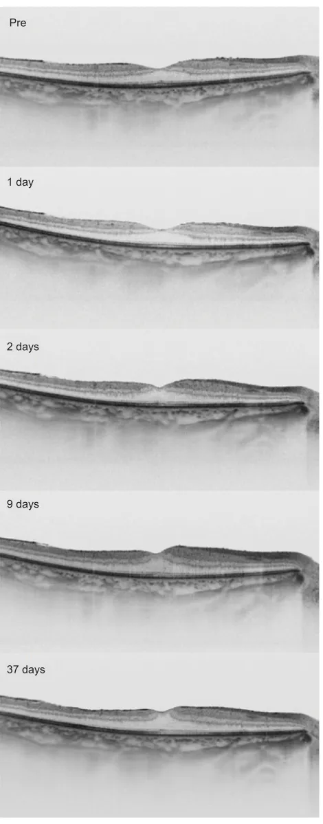 Figure 4 The horizontal cross-sectional swept-source optical coherence tomography images at each visit.Note: Preoperative image with a thin epiretinal membrane is shown at the top, then the images 1 day, 2 days, 9 days, and 37 days after the surgery are shown sequentially 
