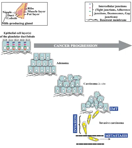 Figure 1.1 Illustration of different stages of progression of breast cancers of epithelial origin, showing that primary tumor cells acquire invasive behavior and become migratory through EMT