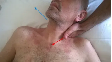 Figure 2 The thumb has to be put under the axilla, with cranial direction toward the coracoid insertion of the muscle, with the force vector being in the oblique axis; once identified the hypertonic area, under the pectoralis major, this position needs to be maintained until myofascial release occurs.Note: The red arrow indicates the direction of the thumb, to the coracoid insertion.