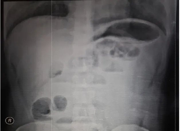 Fig. 1. X-ray abdomen erect: abdomen erect: Showing multiple air fluid levels