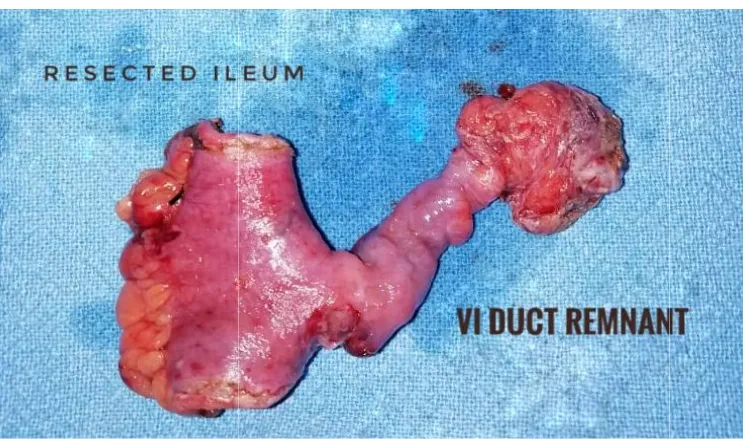 Fig. 2. Laparoscopic finding of persistent vitellointestinal duct Fig. 2. Laparoscopic finding  