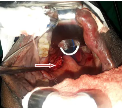 Fig. 2. Mass seen through the left lateral aspect of the oropharynx (arrowed) 