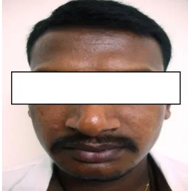 Fig. 1. Frontal view showing mild swelling on 