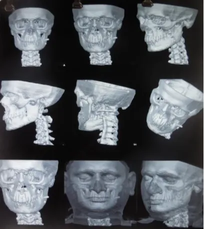 Fig. 5. PA mandible view showing a 