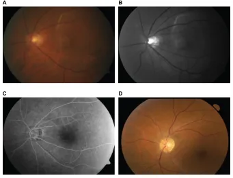 Figure 1 Left fundus photographs of a 74-year-old male.Notes: (A) Fundus at presentation showing a creamy-white lesion above the superior arcade and extending to involve the macular