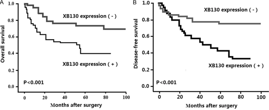 Figure 1. The XB130 protein expression in osteosarcoma tissues. Representative images of XB130 protein im-munostaining in osteosarcoma tissues and the adjacent non-tumor tissue