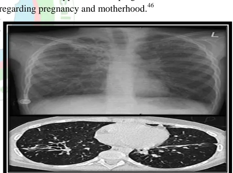 Figure 1: Severe bronchiectasis in end stage cystic fibrosis shown in chest radiograph (top) and computed tomogram (bottom)