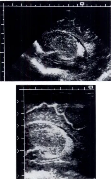 Fig 5.Echodensepatchappearsoppositechoroidglomus,apparentlyinsupraventricularcortexinsectorimage(top).This“sidelobe”artifactdoesnotappearinhigherresolutionlinearformatview(bottom).