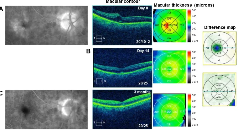 Figure 2 Fluorescein angiography and optical coherence tomography studies for case 2 (Irvine-Gass syndrome).Notes: (A) Cystoid macular edema, macular contour, and macular thickness at presentation