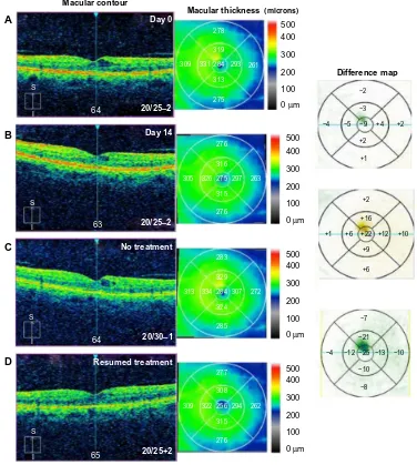 Figure 4 Optical coherence tomography studies for case 4 (diabetic retinopathy).Notes: (A) Macular contour and thickness at presentation