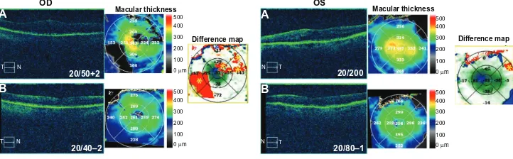 Figure 5 Optical coherence tomography studies for case 5 (uveitis).Notes: (A) Macular contour and thickness at presentation