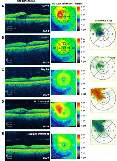 Figure 6 Optical coherence tomography studies for case 6 (branch retinal vein occlusion).Notes: (A) Macular contour and thickness at presentation