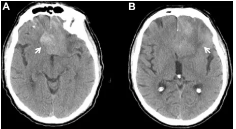 Figure 1 axial Ct demonstrates midline hyperdensity (arrow; A), and left frontal surrounding hypodensity (arrow; B).Abbreviation: Ct, computed tomography.